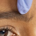 What are the Benefits and Risks of Botox Injections?