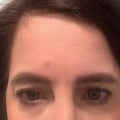 How much botox can get on the forehead?