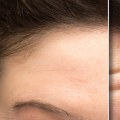 How Long Does Botox Last? Expert Advice on Maximizing Results