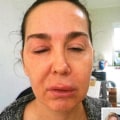 Can Botox Injections be Toxic?