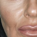 What Happens to Your Face When You Get Botox?