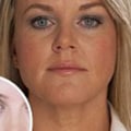 What Happens if Botox Enters the Bloodstream?