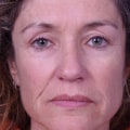 Botox in Denver CO