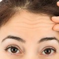 How Long Can You Use Botox For Anti-Aging?