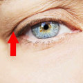 How Long Do the Side Effects of Botox Injections Last?