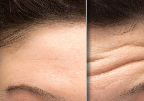 Does botox go away faster the first time?