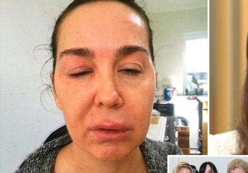 Can Botox Injections be Toxic?