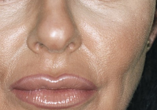 Does botox change your face?