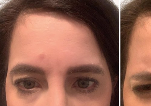 How Many Units of Botox Do You Need for Your Forehead?