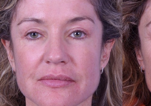 Botox in Denver CO