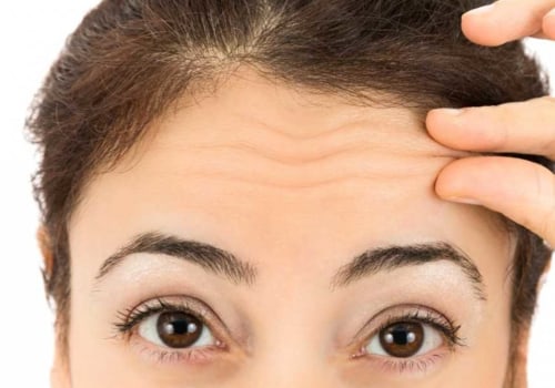 How Long Can You Use Botox For Anti-Aging?